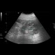 Renal cell carcinoma: US - Ultrasound